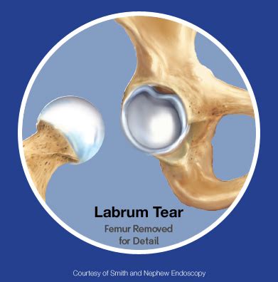 acetabular labrum tear pain characteristics